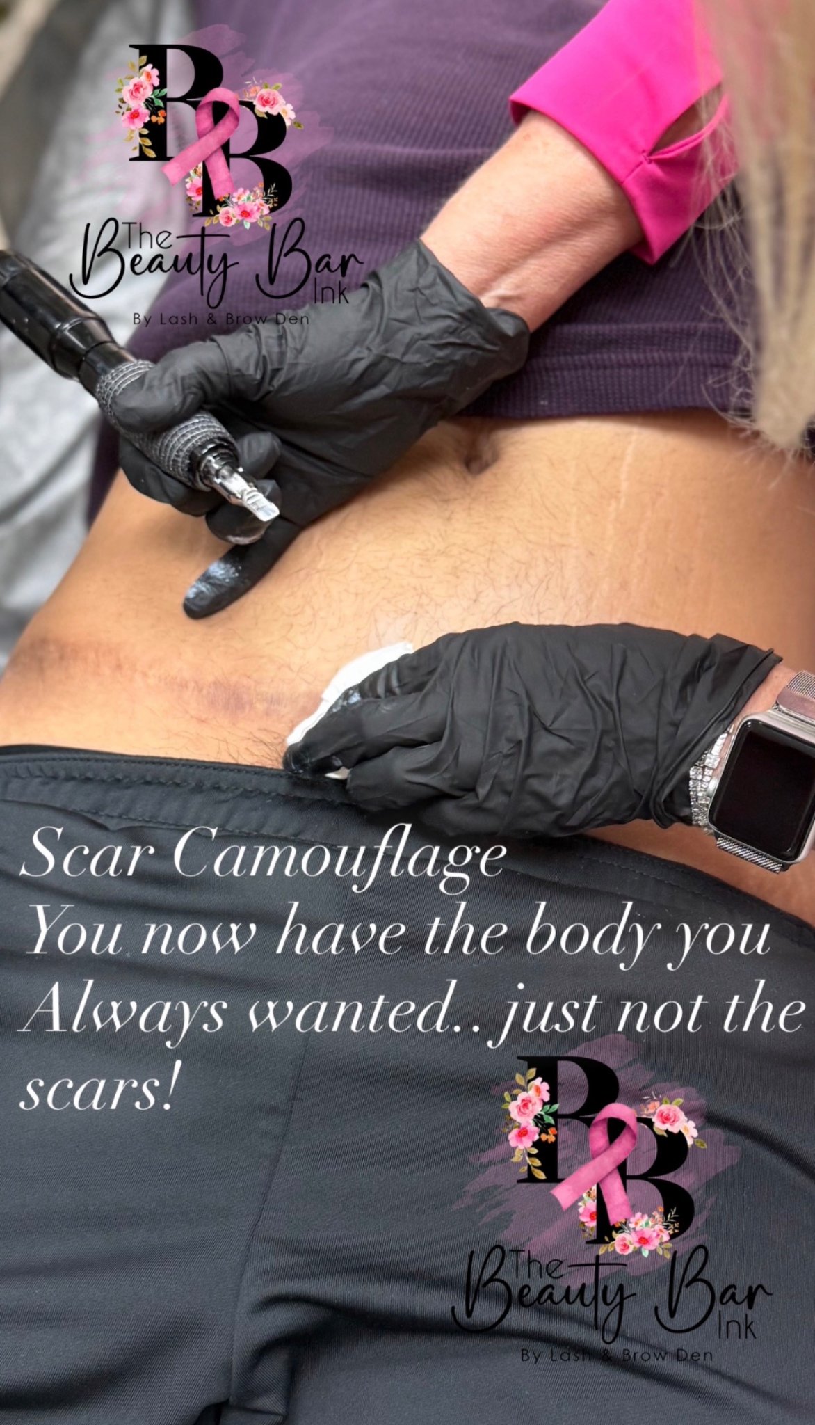 Scar camouflage result